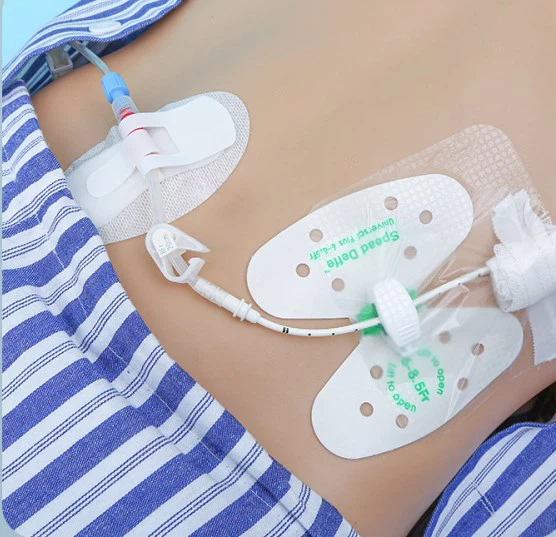 Medical Stabilization Device for Biliary Catheter